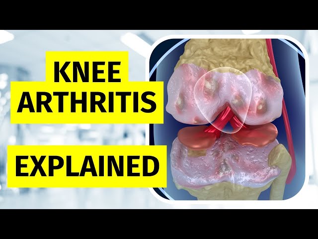 Knee Arthritis Explained - Treatments and Injections