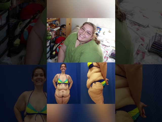 Guess the weight of this huge body lift specimen (COMMENT BELOW)