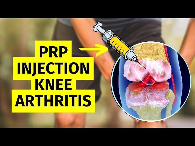 Can PRP Injections ACTUALLY Delay Knee Replacement Surgery?