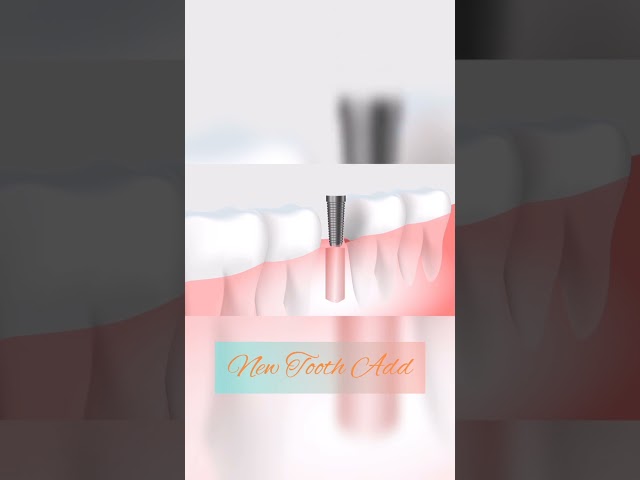New Tooth Add using Technology