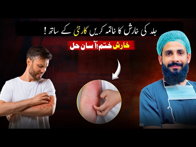Scabies Treatment | Home Remedies | Relief from Itching