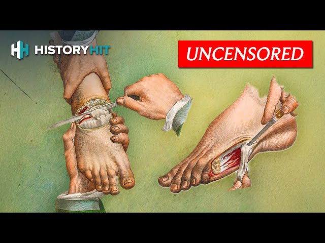 Medical History: Amputations In The Battlefield