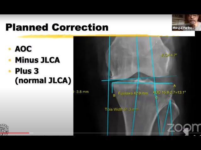 Knee osteotomy by fixator