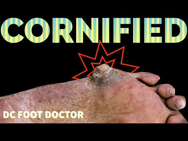 Cornified: Extremely Thick and Hard Callus Removal