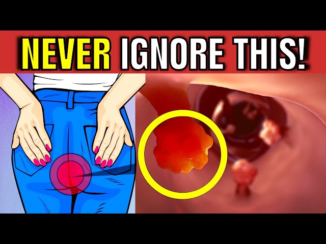 7 Warning Signs of Colon Cancer You Should NEVER Ignore!