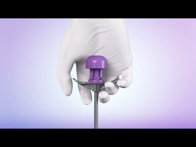 Insert PEG tube via direct puncture