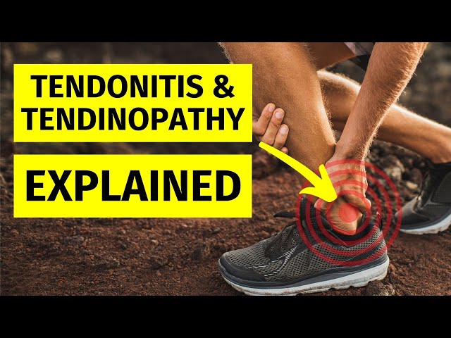 Tendinopathy & Tendonitis Explained