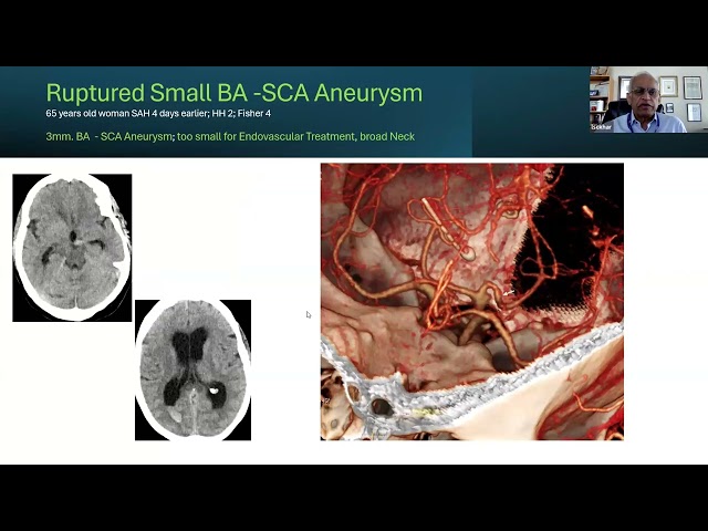 Dr. Laligam N. Sekhar, MD, FACS, FAANS 2025 Drake Lecture (10/13/2025)