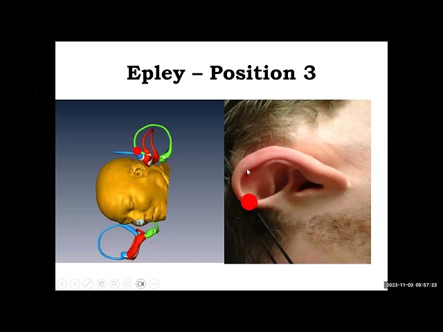 A Simple Way to Visualize Posterior Canal BPPV