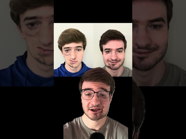 My Face Before and After Surgery