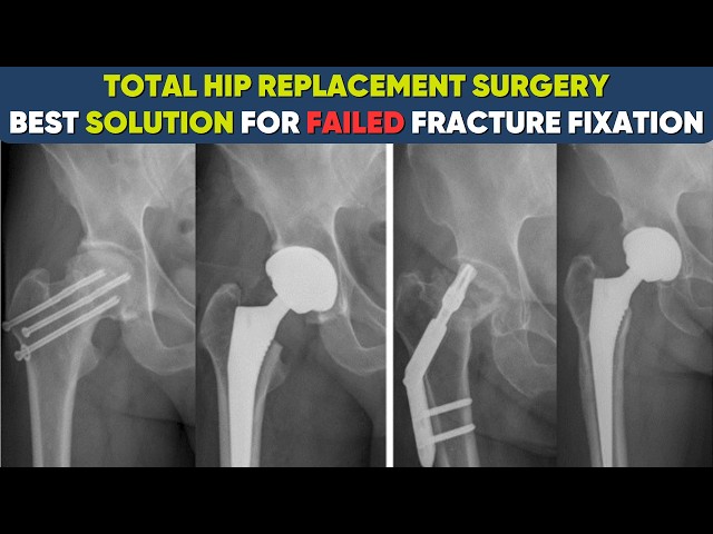 Hip Replacement in Failed Hip Fracture Surgery #hipfracture 