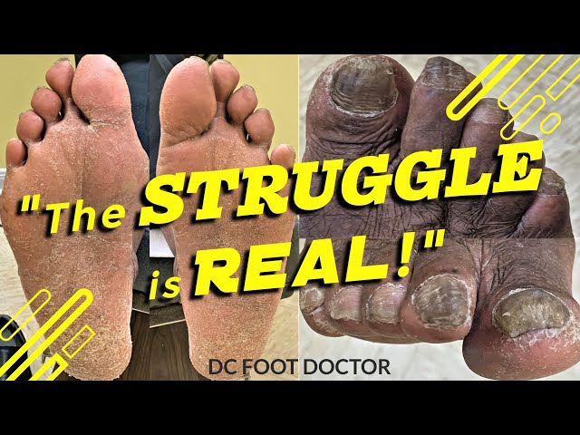 The Struggle is Real:  Struggling with Foot Care and Underlying Health Issues; Toenails and Calluses