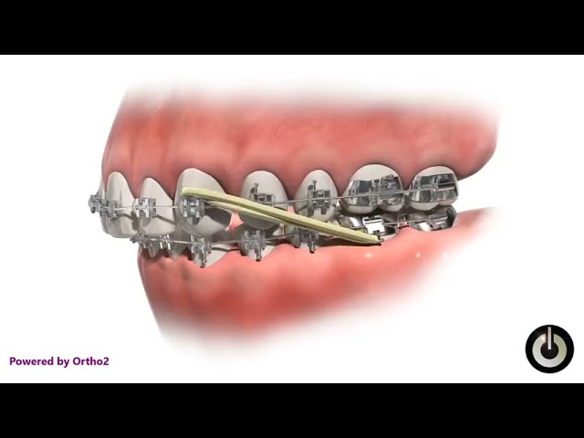 Orthodontic 🦷 تقويم الأسنان #dental #اسنان
