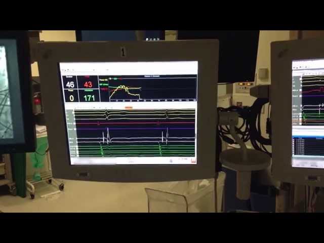4 SVT Testing after the ablation final