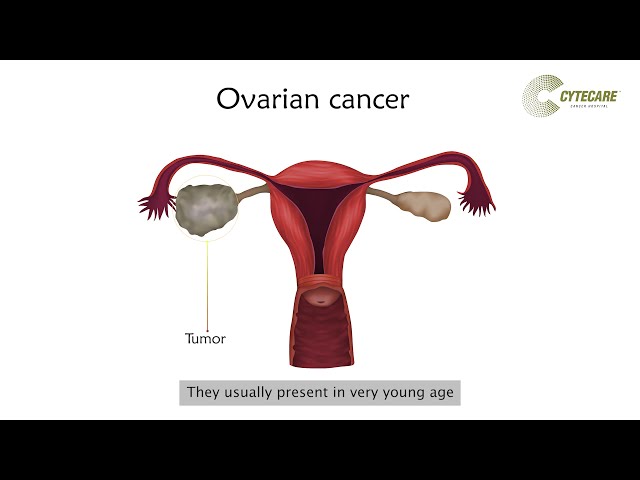 Ovarian Cancer Insights: Symptoms And Diagnosis | #OvarianCancer | Cytecare Cancer Hospital