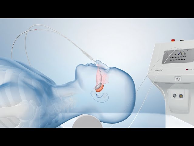 Cancer Treatment with Brachytherapy (Medical Animation)