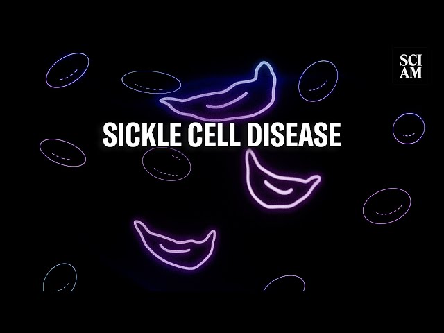 What is Sickle Cell Disease? And Can Science Cure it?