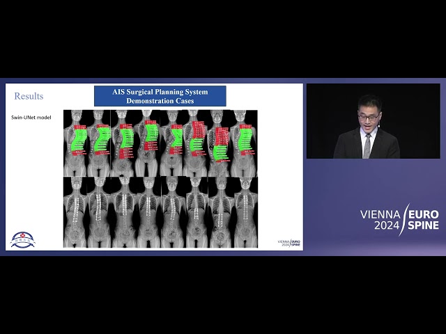 Computer-aided planning of surgical fusion level for adolescent idiopathic sc | Mao | EUROSPINE 2024