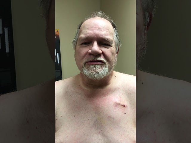 Heart failure patient feels better with cardiac resynchronization therapy (CRT)