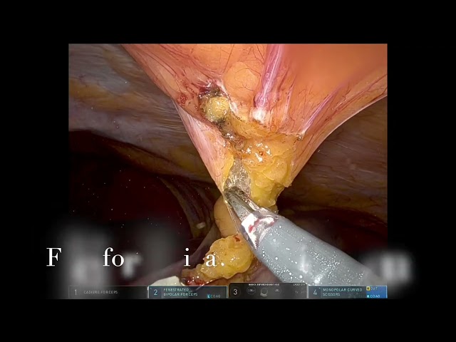 Robotic Cytoreductive Surgery With HIPEC