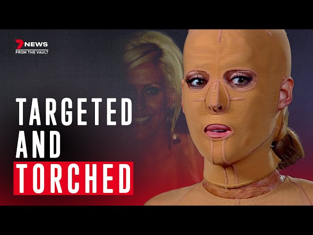 The girl behind the mask: burned in a jealous rage | True Crime
