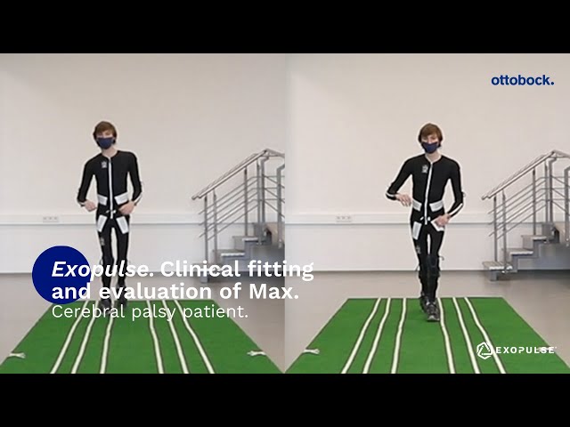 Max's cerebral palsy related spasticity symptoms before & after wearing the Exopulse Mollii Suit