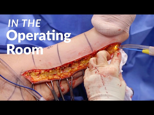 Woman Goes Under the Knife to Remove Excess Arm Skin (Graphic Surgery Video)