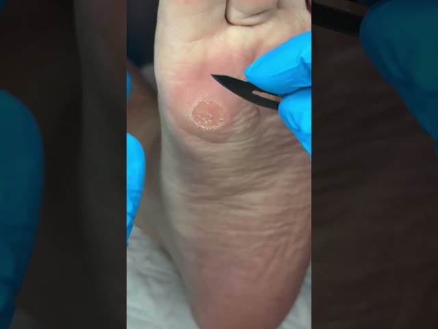 Callus Therapy Sounds🔊ASMR