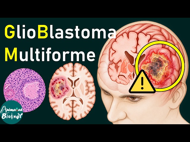 GBM Explained | Glioblastoma Pathology, Necrosis & Microvascular Proliferation