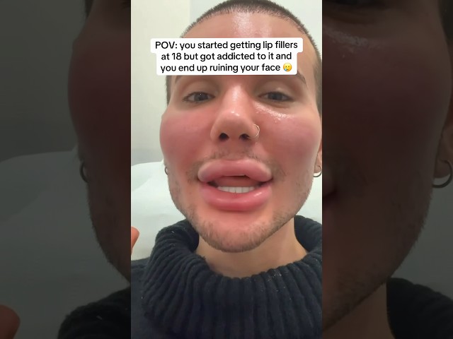 PLEASE DONT GET ADDICTED TO FILLERS😭 #filler #fillers #botox #plasticsurgery #lipfiller #beautytips