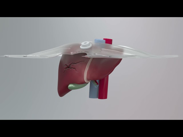 The Liver Airbag: A Novel Surgical Tool for Liver Trauma Management