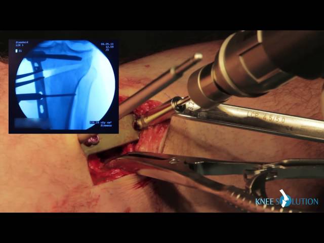 High Tibial Osteotomy (HTO)