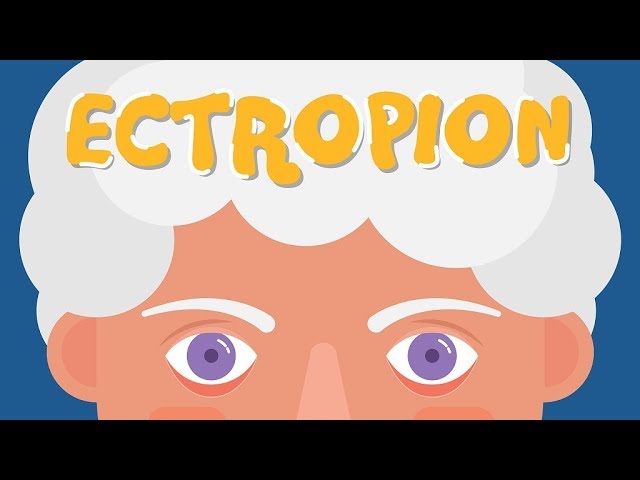 What is Ectropion?