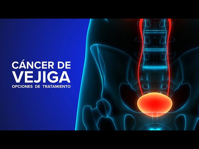 Cáncer de Vejiga - Una experta explica opciones de tratamiento |  UC Davis Health