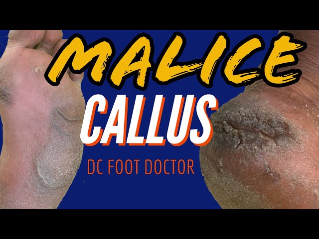 Malice Callus: Severe Calluses and Fissures  (Size 13 Feet)