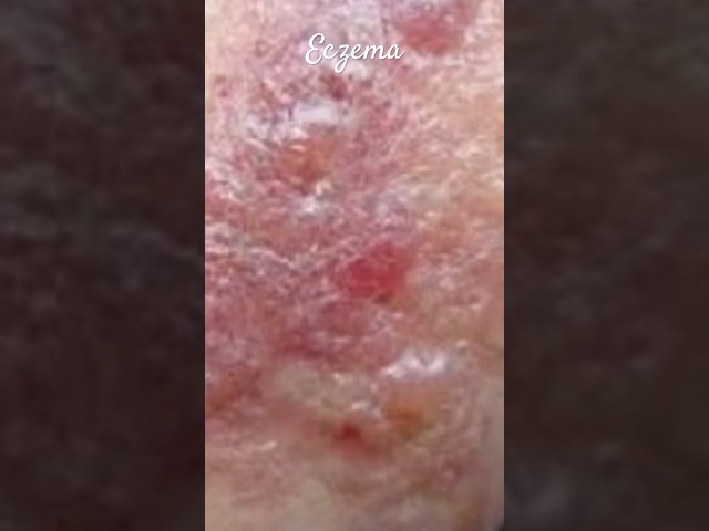 Eczema