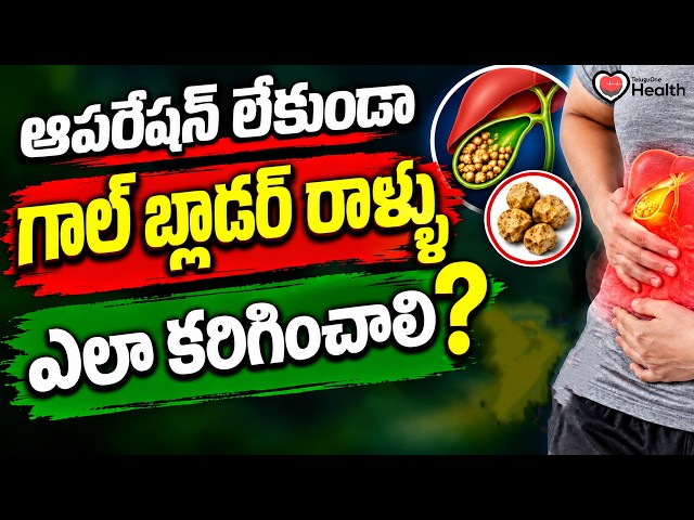 ఆపరేషన్ లేకుండా గాల్ బ్లాడర్ రాళ్లను ఎలా కరిగించాలి? | Dr. S.G.V. Satya | TeluguOneHealth