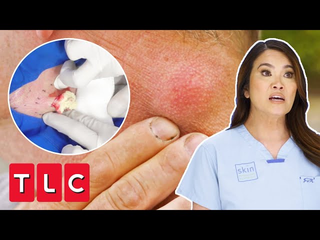 “It’s Like Mashed Potatoes” Dr Lee Removes 20 Year Old Cyst On Man’s Neck | Dr Pimple Popper Pop Ups