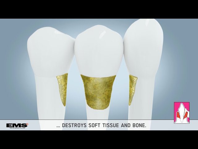 Professional Teeth Cleaning with Air Flow | Medical Animation