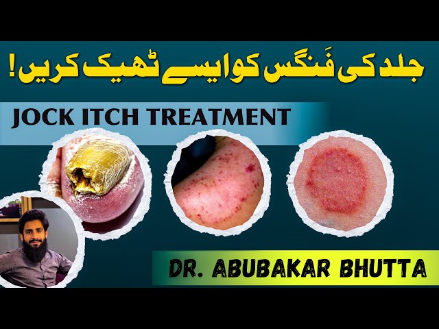 How to treat FUNGAL INFECTION |Treatment of fungal skin infection | Dr. AbuBakar Bhutta