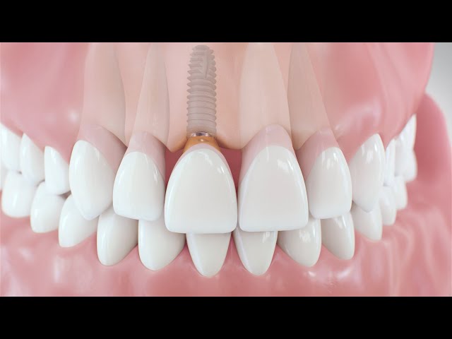 Dental Implant Procedure | Medical Animation