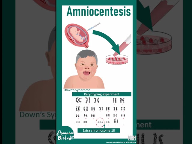 Amniocentesis | Why Do Doctors Do Amniocentesis ? |  #animated_biology #bio_facts