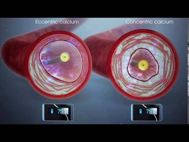 Shockwave IVL Therapy