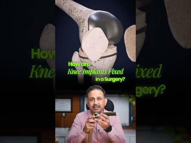 Cement in knee replacement Keeps a Knee Implant in Place- did you know that ? #drpankajwalecha