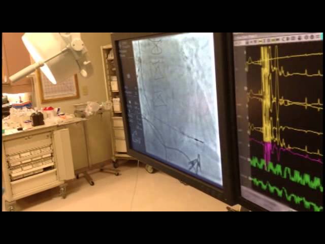 7 Pacemaker - Fixing the lead in the heart