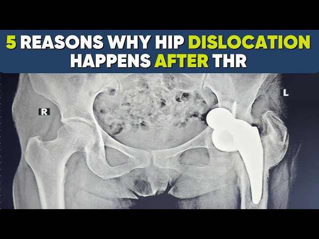 5 Reasons Why Hip Dislocation Happens After Hip Replacement Surgery