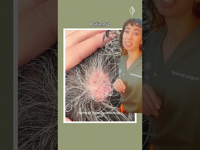 Before and After 1 Treatment for Alopecia Areata  Hair Loss