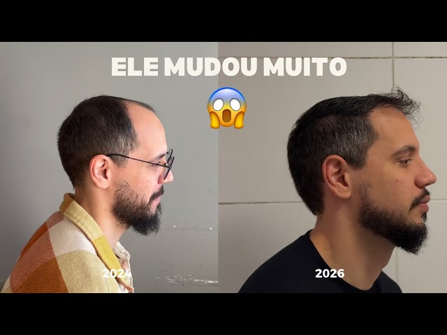 Everything about my husband's hair transplant - VIIHROCHA