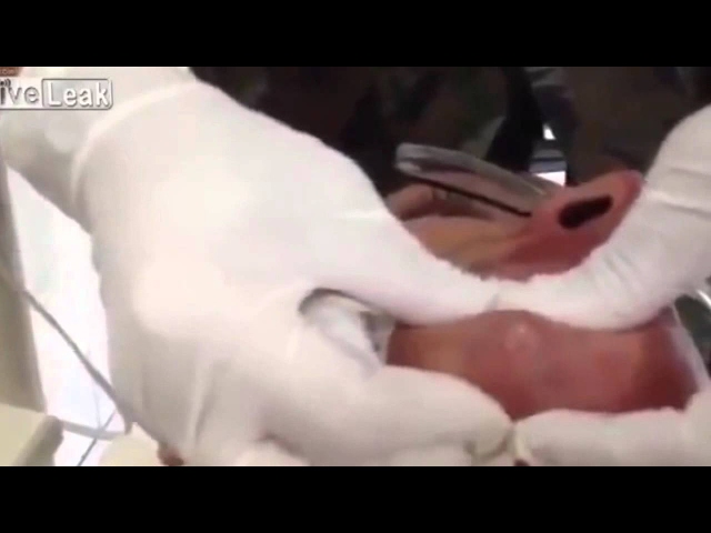 Biggest Botfly larvae ever in humans/ botfly removal from chin
