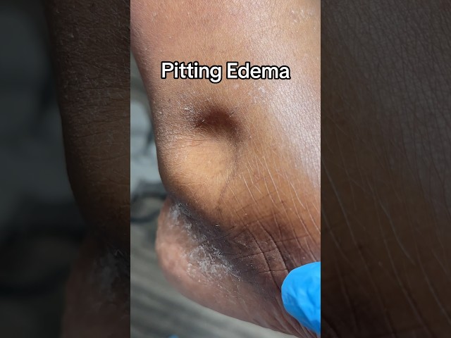 Pitting edema #podiatry #pittingedema #swelling #cardiovasculardisease